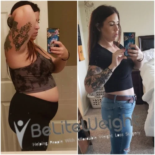 Weight Loss Surgery Before And After
